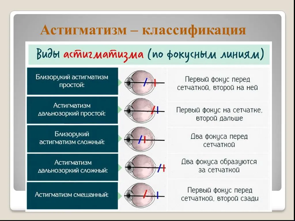 Классификация астигматизма Классификация астигматизма