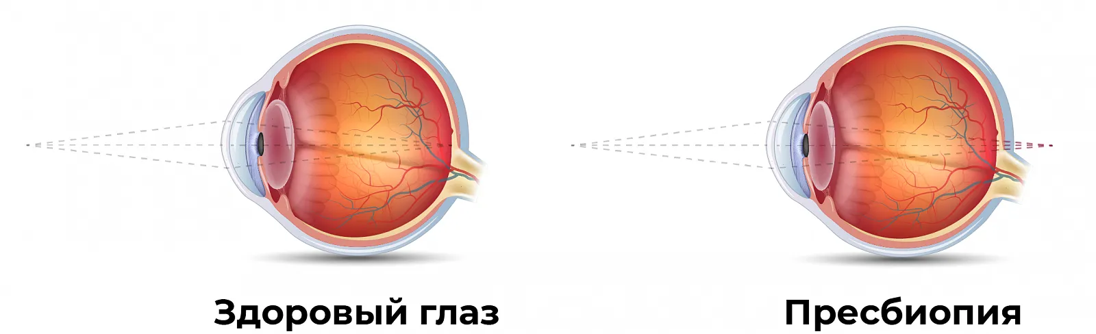 Пресбиопия, два глаза Пресбиопия