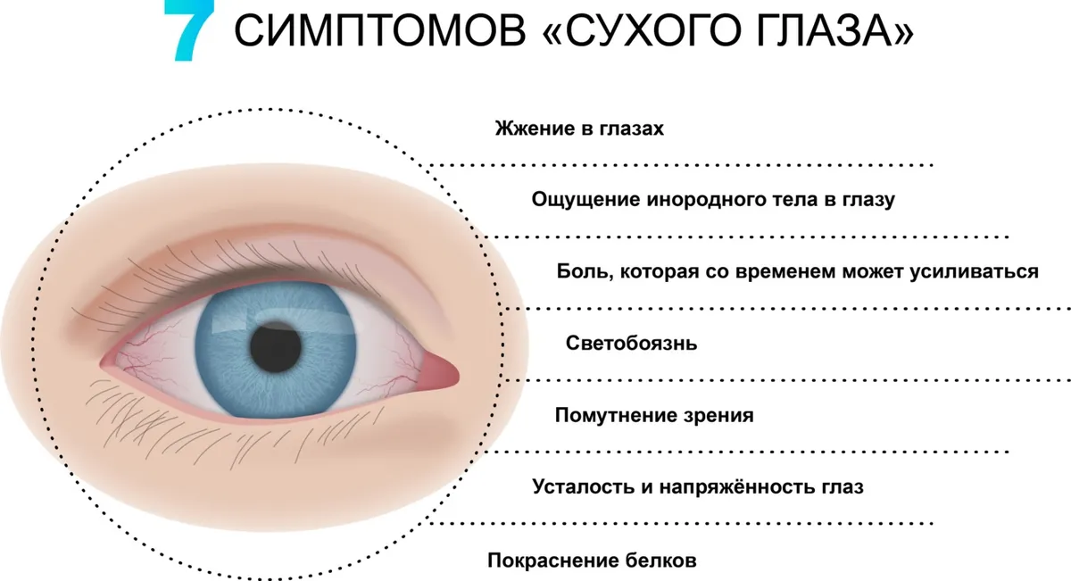 Семь симптомов сухого глаза, пункты Семь симптомов сухого глаза