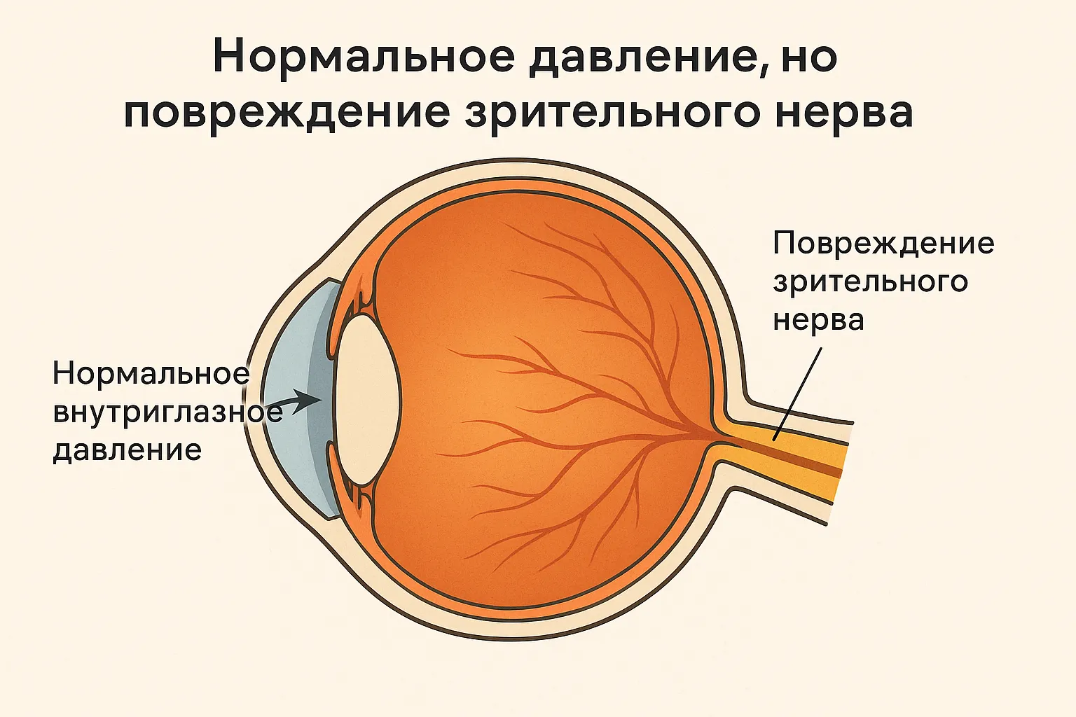 Нормотензивная глаукома, нормальное давление Нормотензивная глаукома