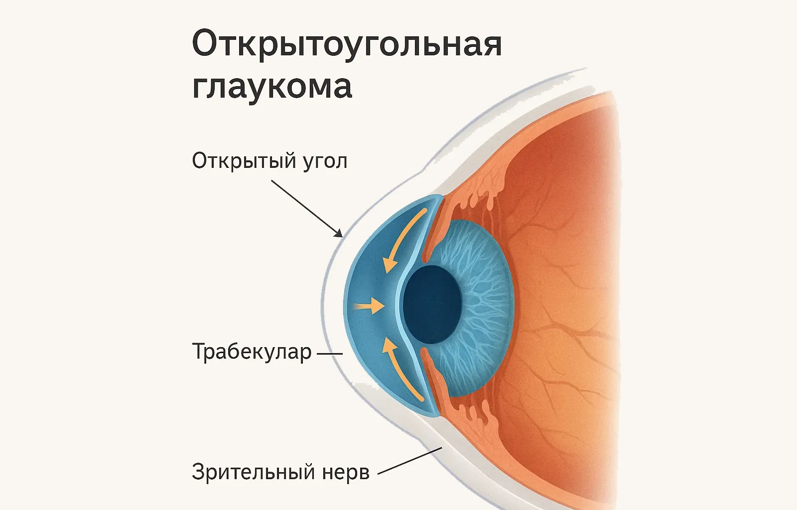 Открытоугольная глаукома