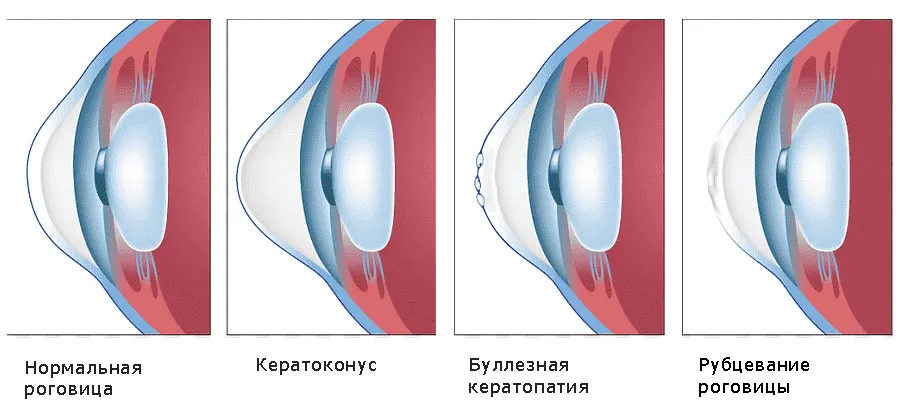 Кератоконус