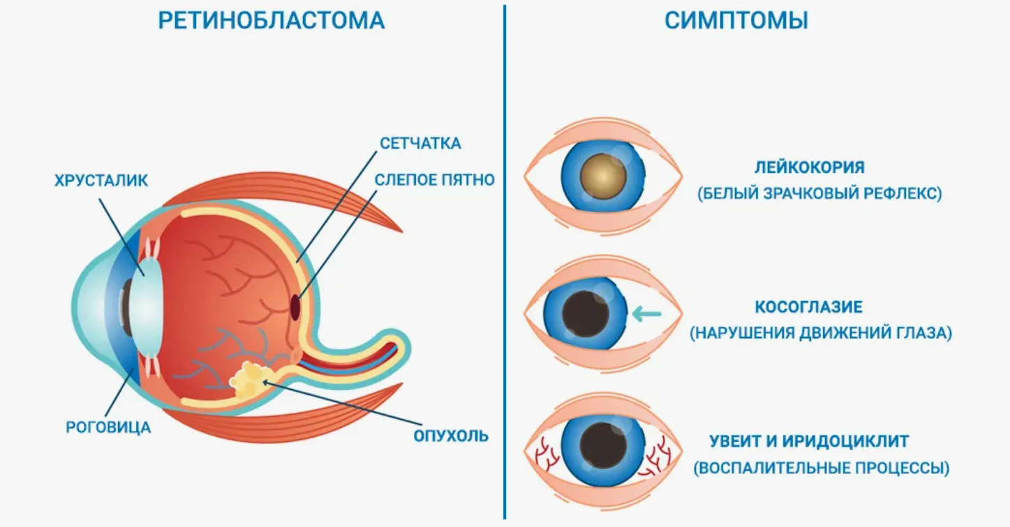 Ретинобластома, симптомы Ретинобластома