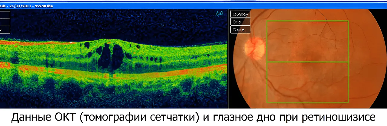 Ретиношизис сетчатки Ретиношизис сетчатки