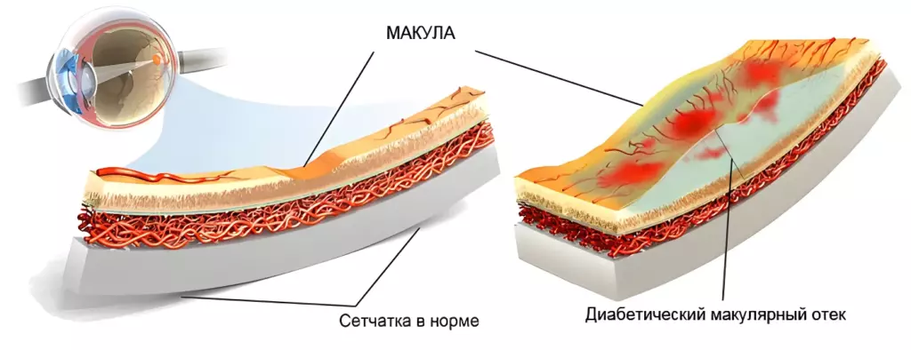 Диабетический макулярный отек Диабетический макулярный отек