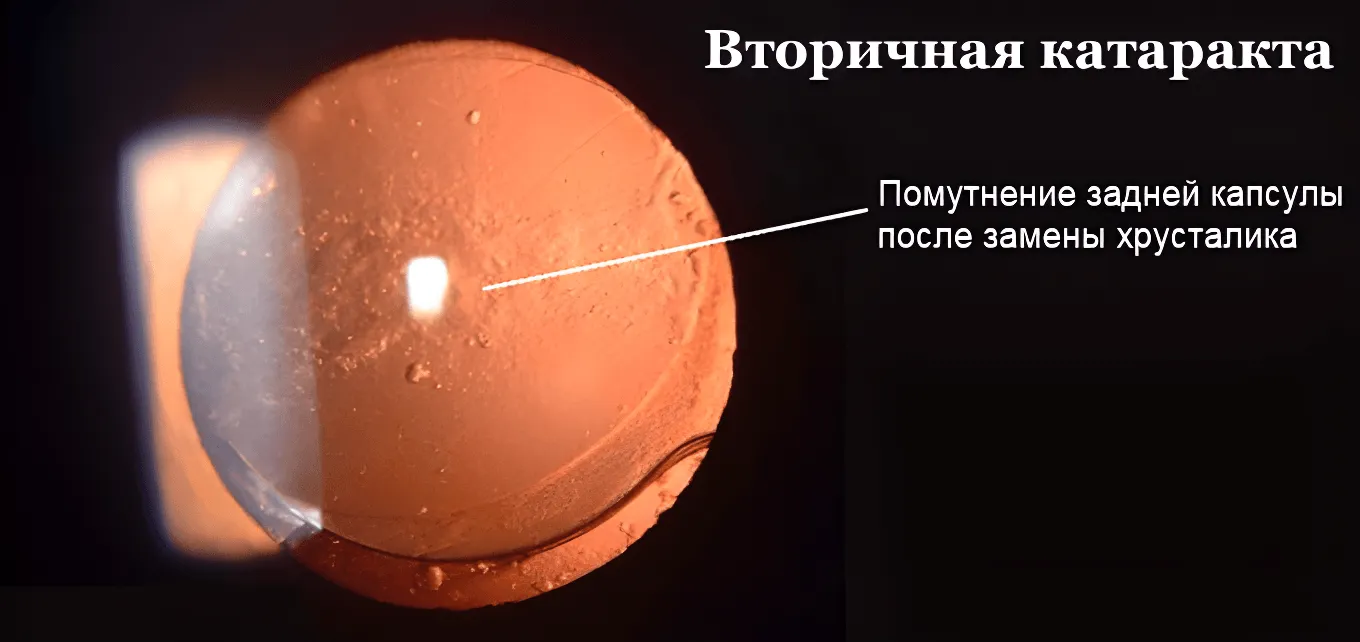 Вторичная катаракта