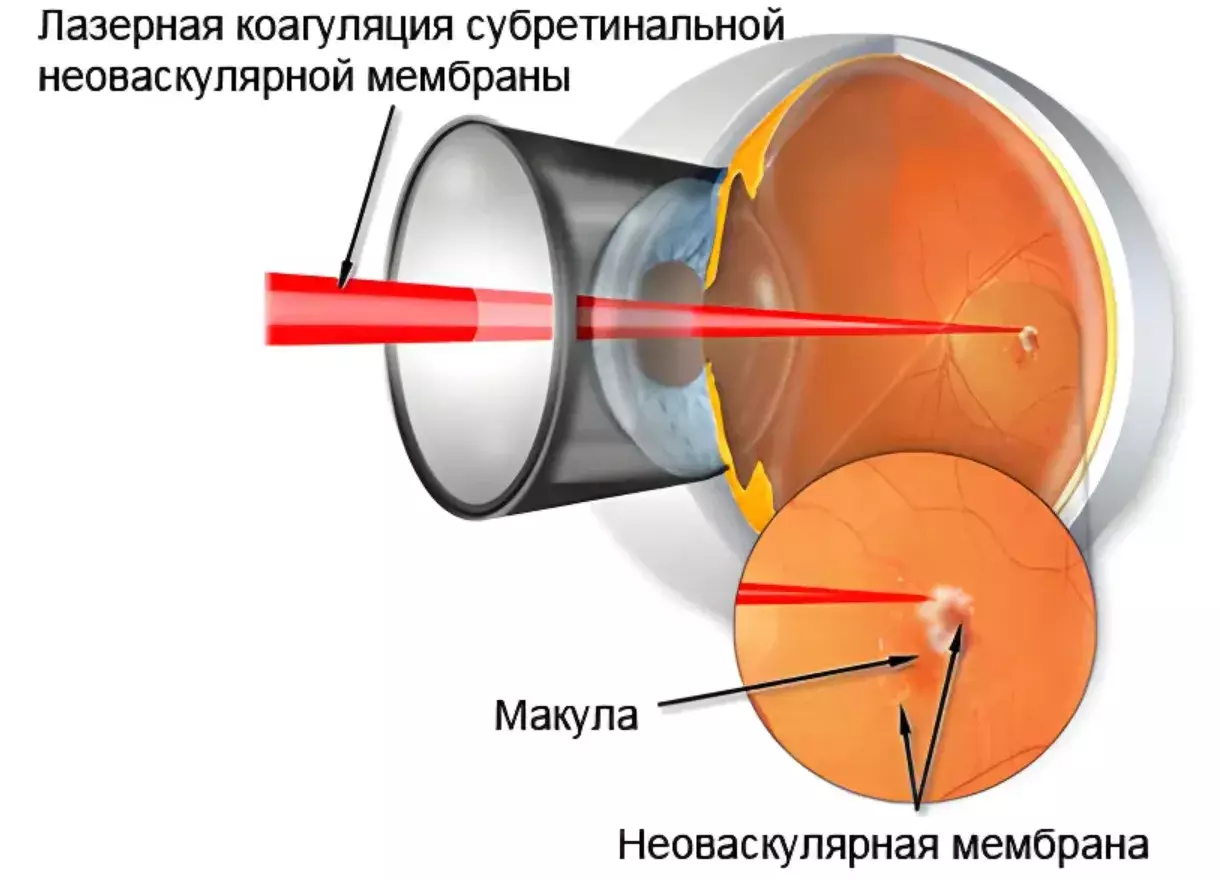 Лазерное лечение дегенерации сетчатки Лазерное лечение дегенерации сетчатки