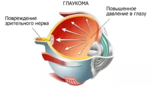 Глаукома