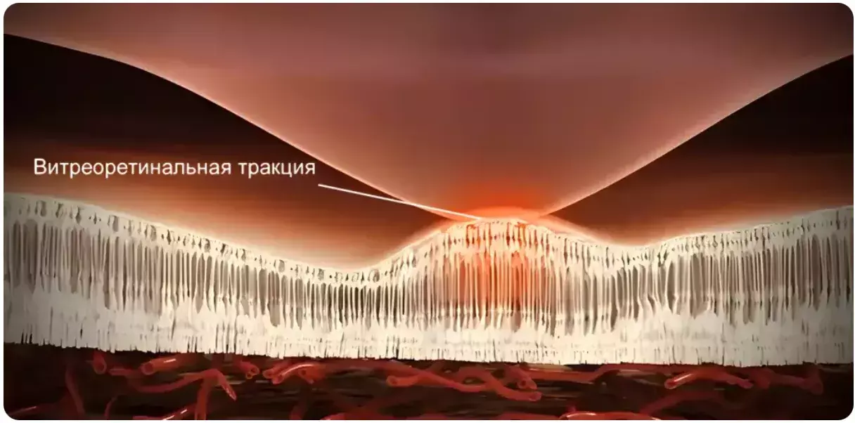 Тракционный макулярный отек сетчатки Тракционный макулярный отек сетчатки