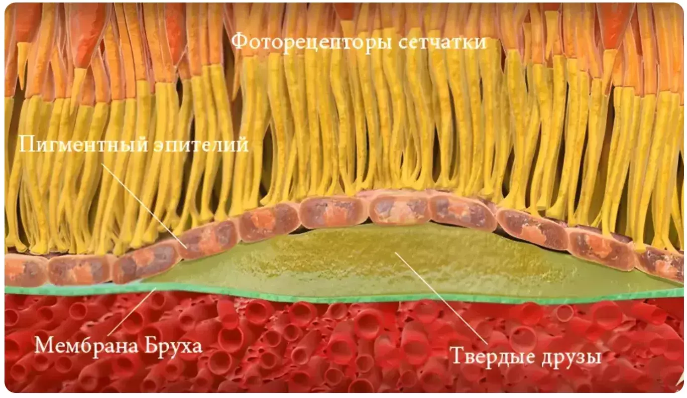 Макулярная дегенерация. Сухая форма Макулярная дегенерация. Сухая форма