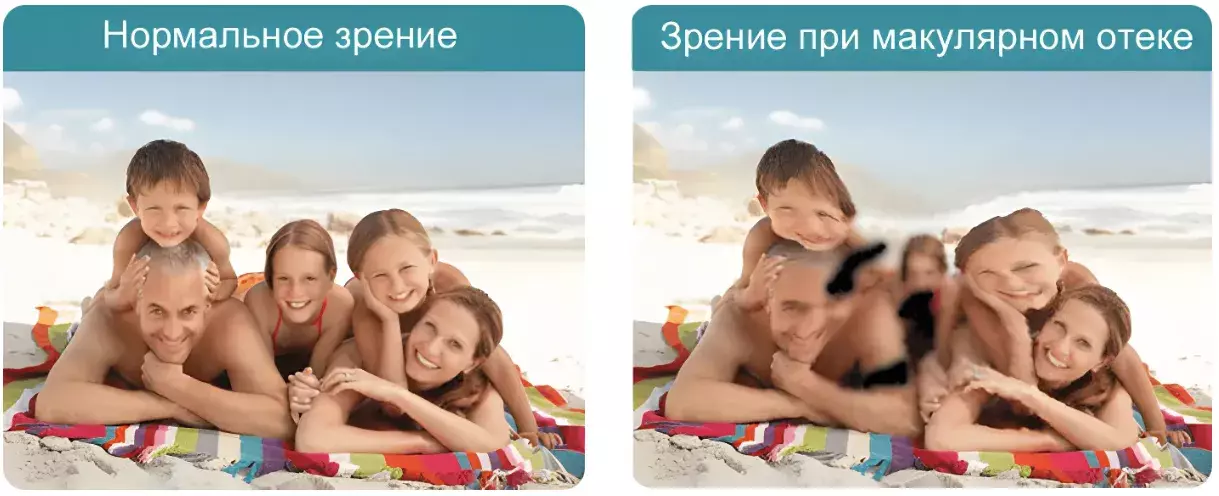 Симптомы отека макулы Симптомы отека макулы