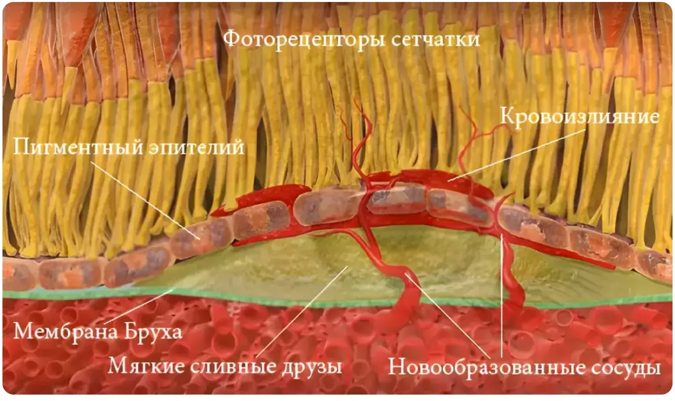 Возрастная макулярная дегенерация сетчатки. Влажная форма Возрастная макулярная дегенерация сетчатки. Влажная форма