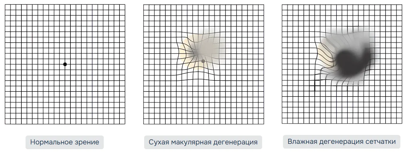 Тест Амслера Тест Амслера