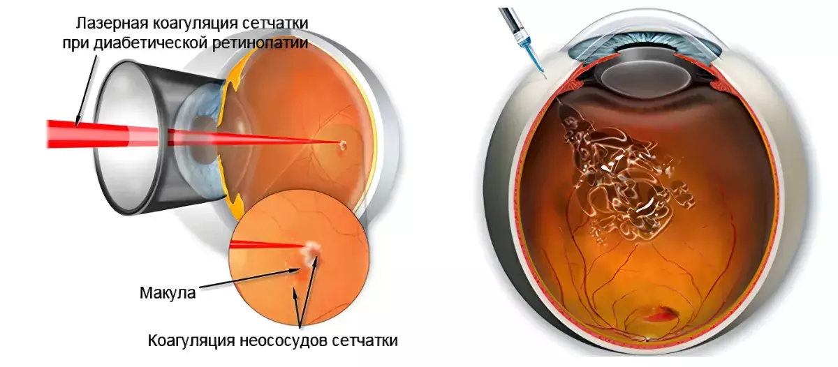 Лазерное лечение макулярного отека и Интравитреальное введение anti-VEGF Лазерное лечение макулярного отека и Интравитреальное введение anti-VEGF