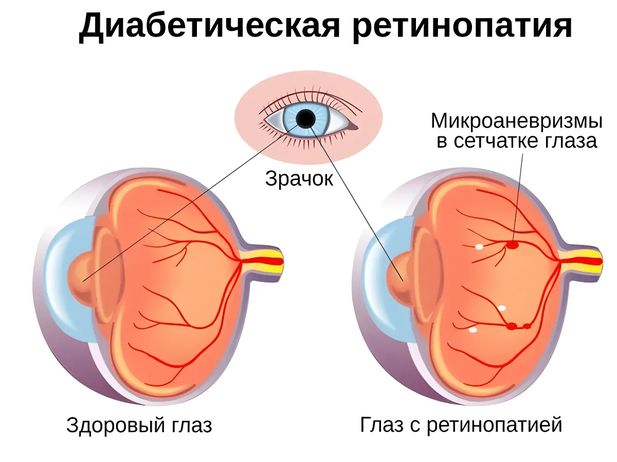 Признаки диабетической ретинопатии Признаки диабетической ретинопатии